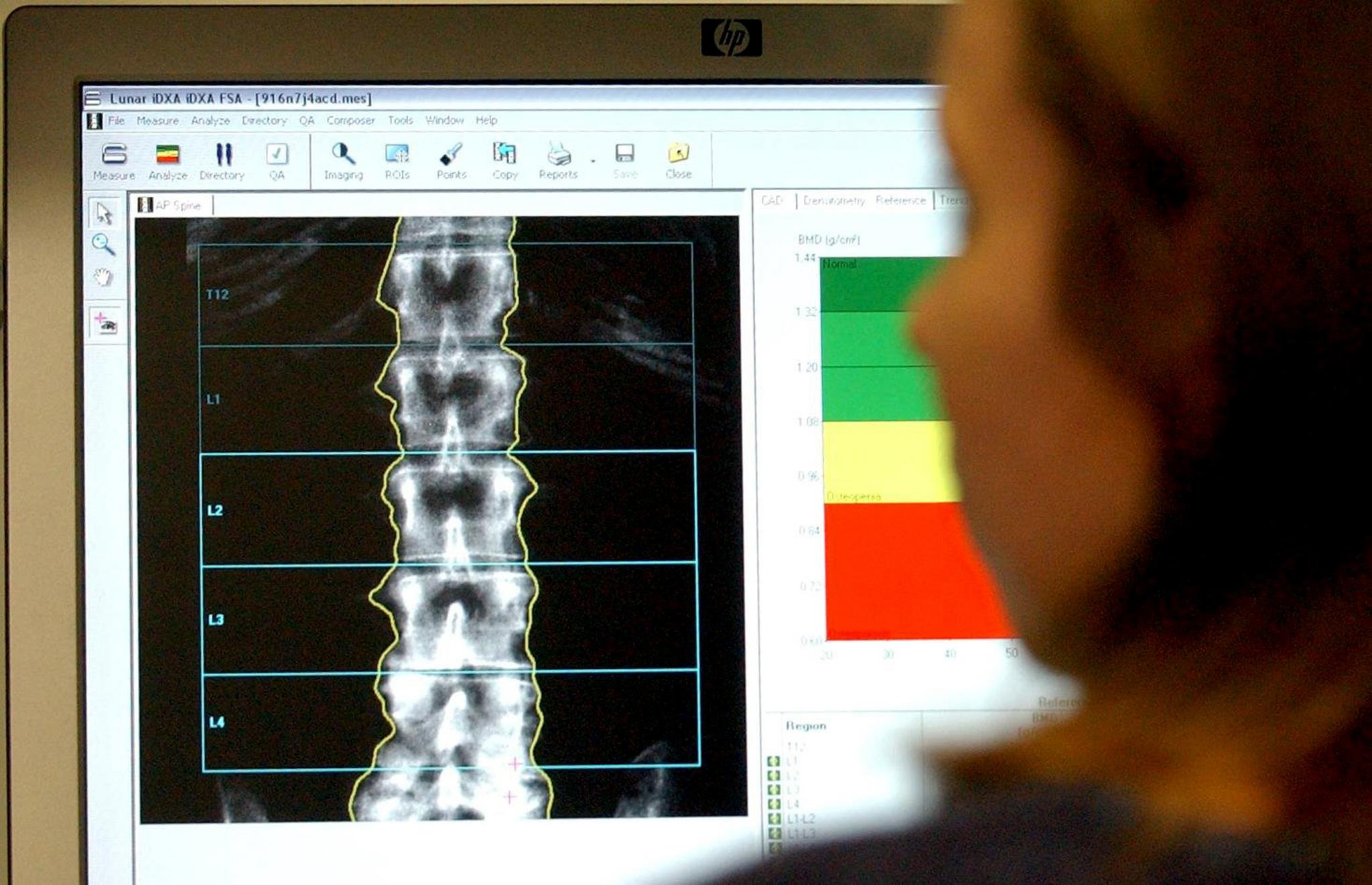 A fifth of people in Devon suffer joint, bone and muscle conditions