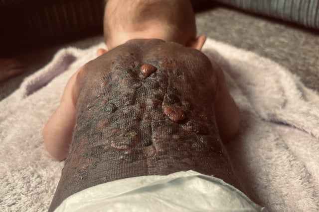 Plymouth Mum speaks out over rare birthmark